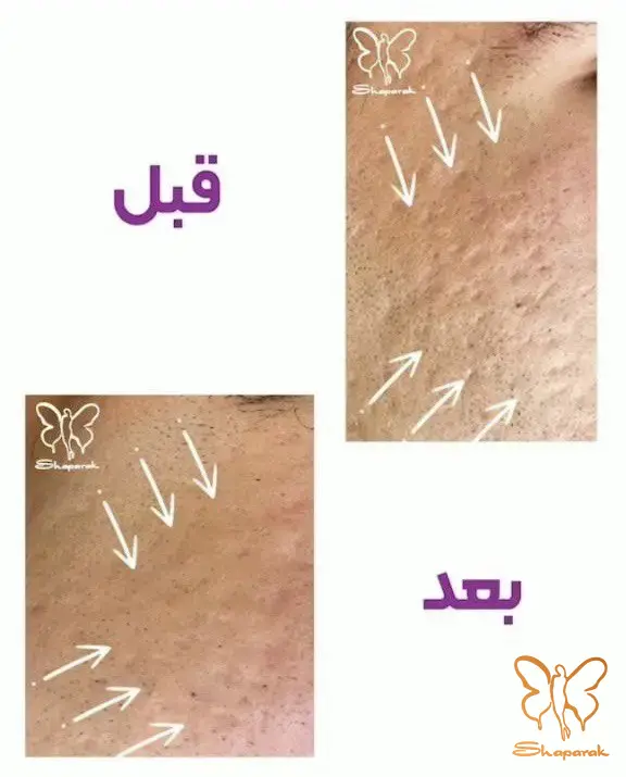 درمان جای جوش با لیزر در مشهد